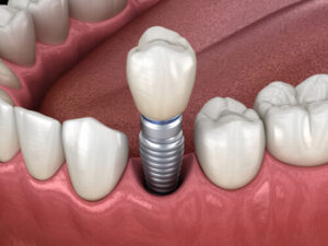 cheap dental implant procedure